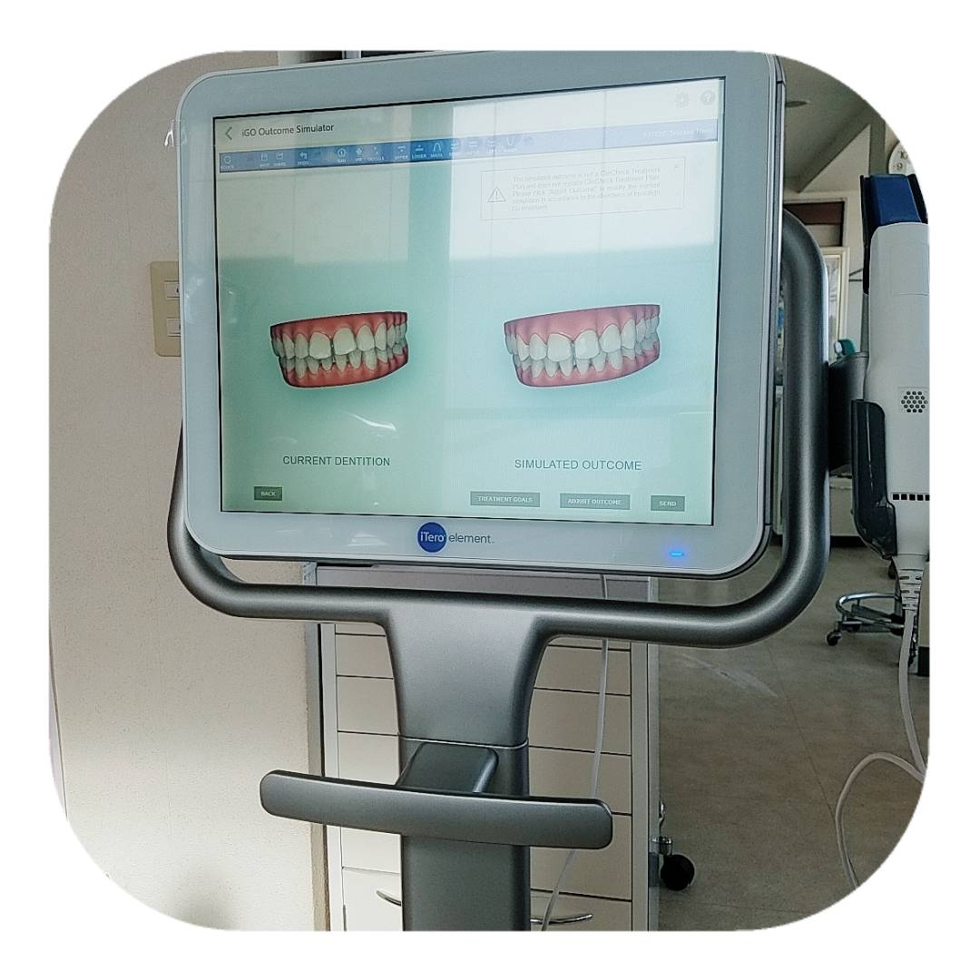 3D口腔内スキャナーiTeroエレメントで歯型をとりますので治療前に仕上がりイメージが即日確認可能です。